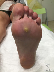Papiloma en el pie
