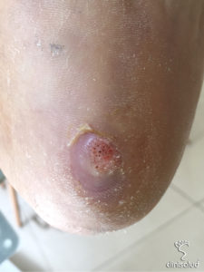 Papiloma tratamiento 