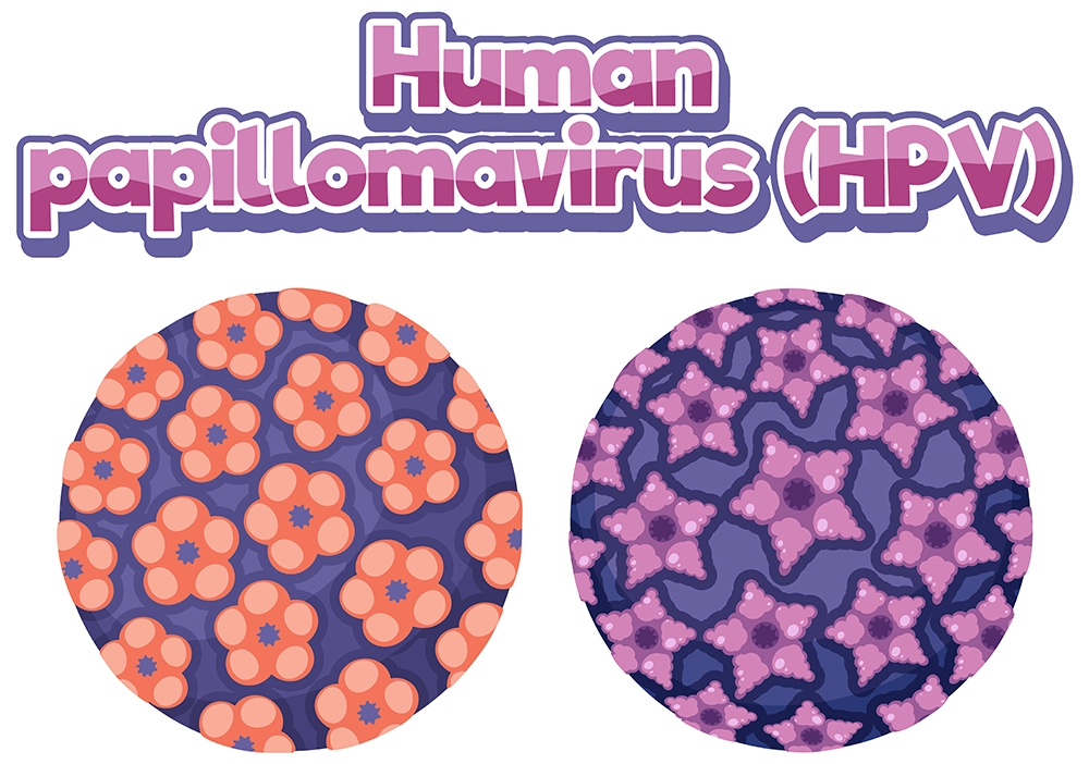 virus del papiloma humano