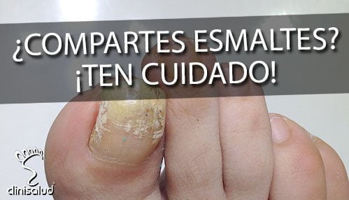 Hongos en esmaltes de uñas