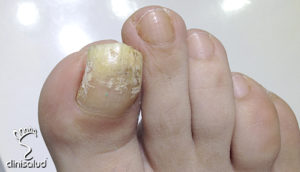 Hongos en la uñas