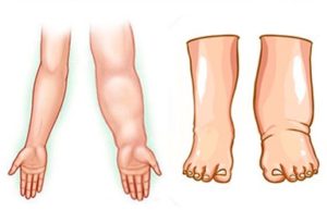 Linfedema Albacete