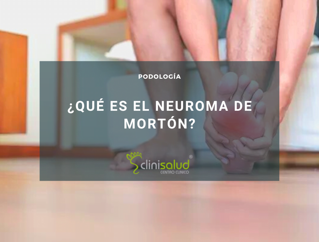 Síntomas del neuroma de Morton