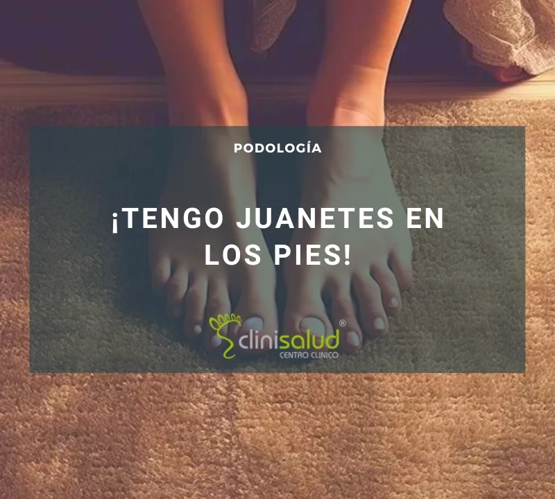 Tengo juanetes en los pies | Clinisalud