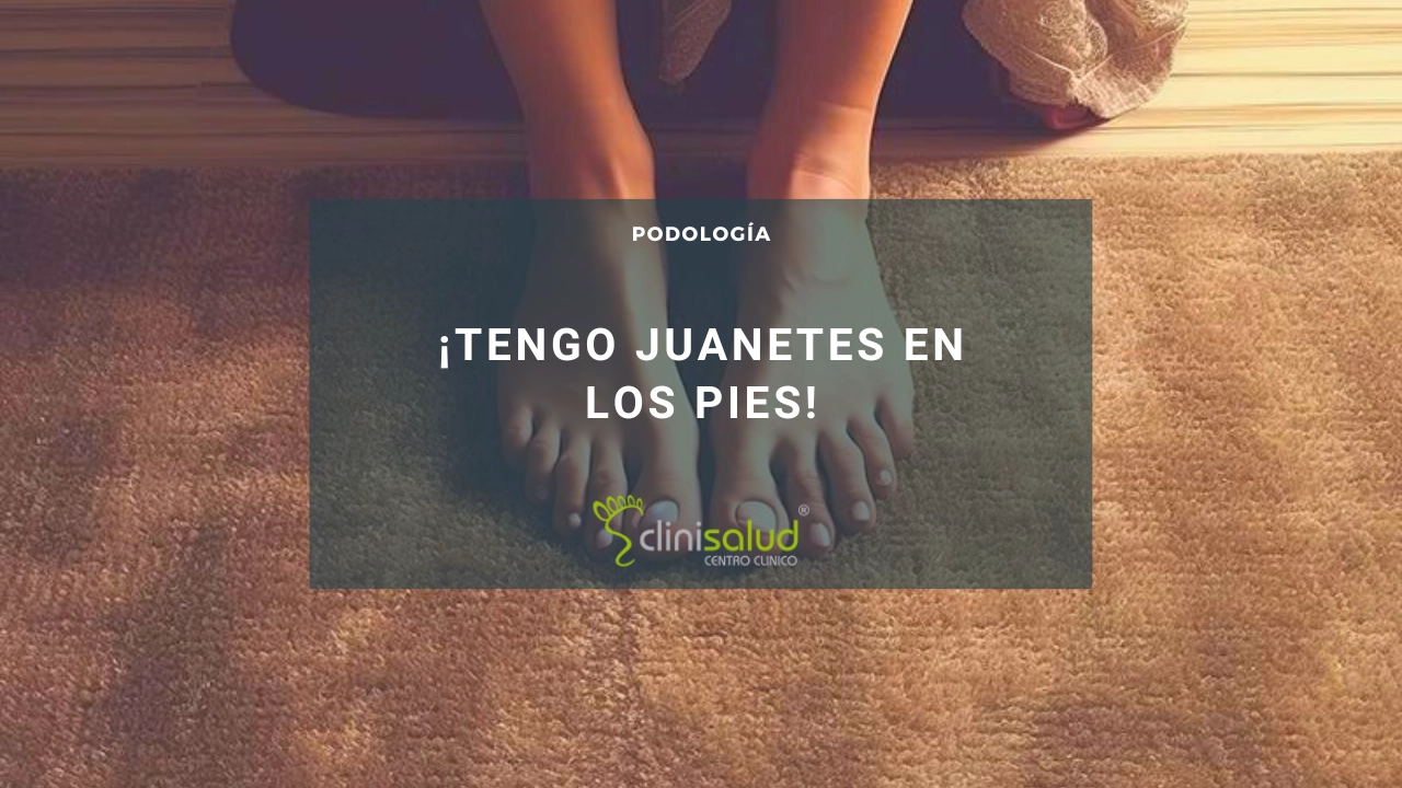 Tengo juanetes en los pies | Clinisalud