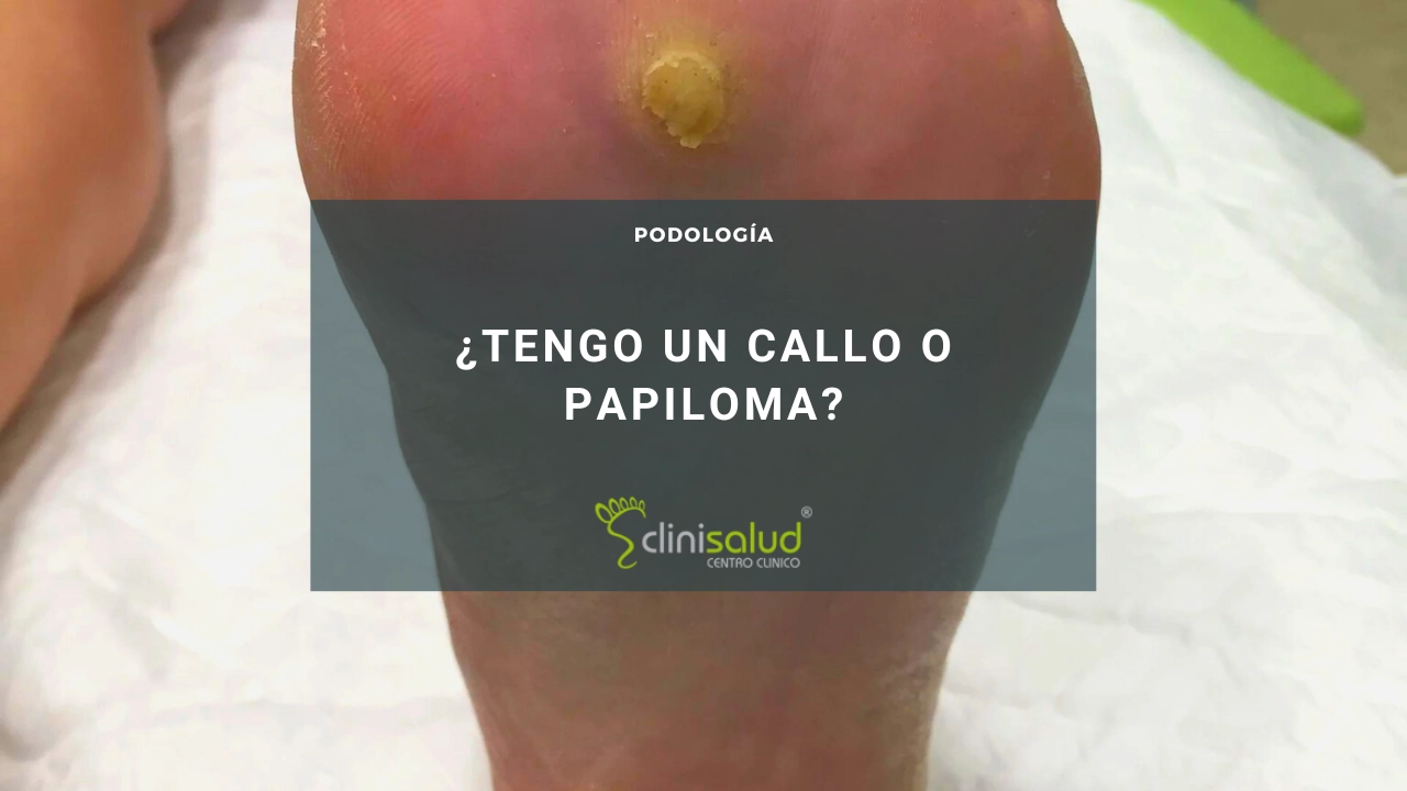 Papiloma en el pie | Clinisalud