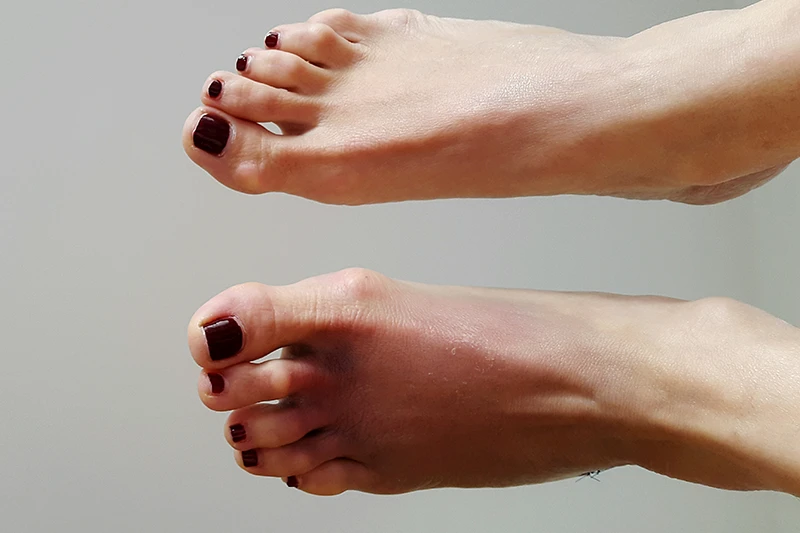 tratamientos para los pies en garra