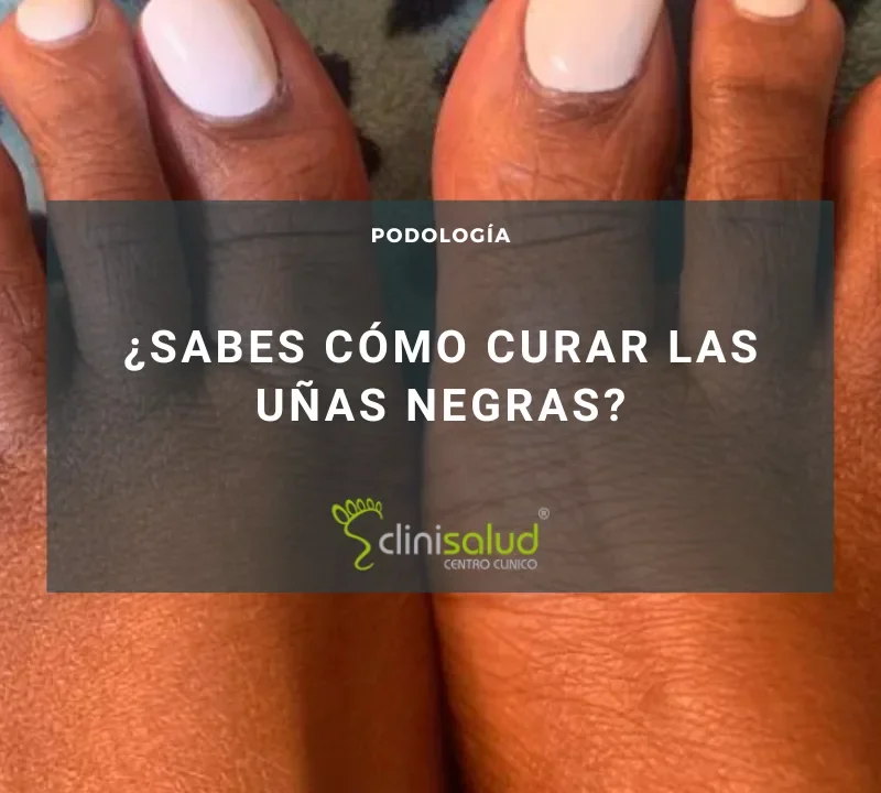 CURAR LAS UÑAS NEGRAS