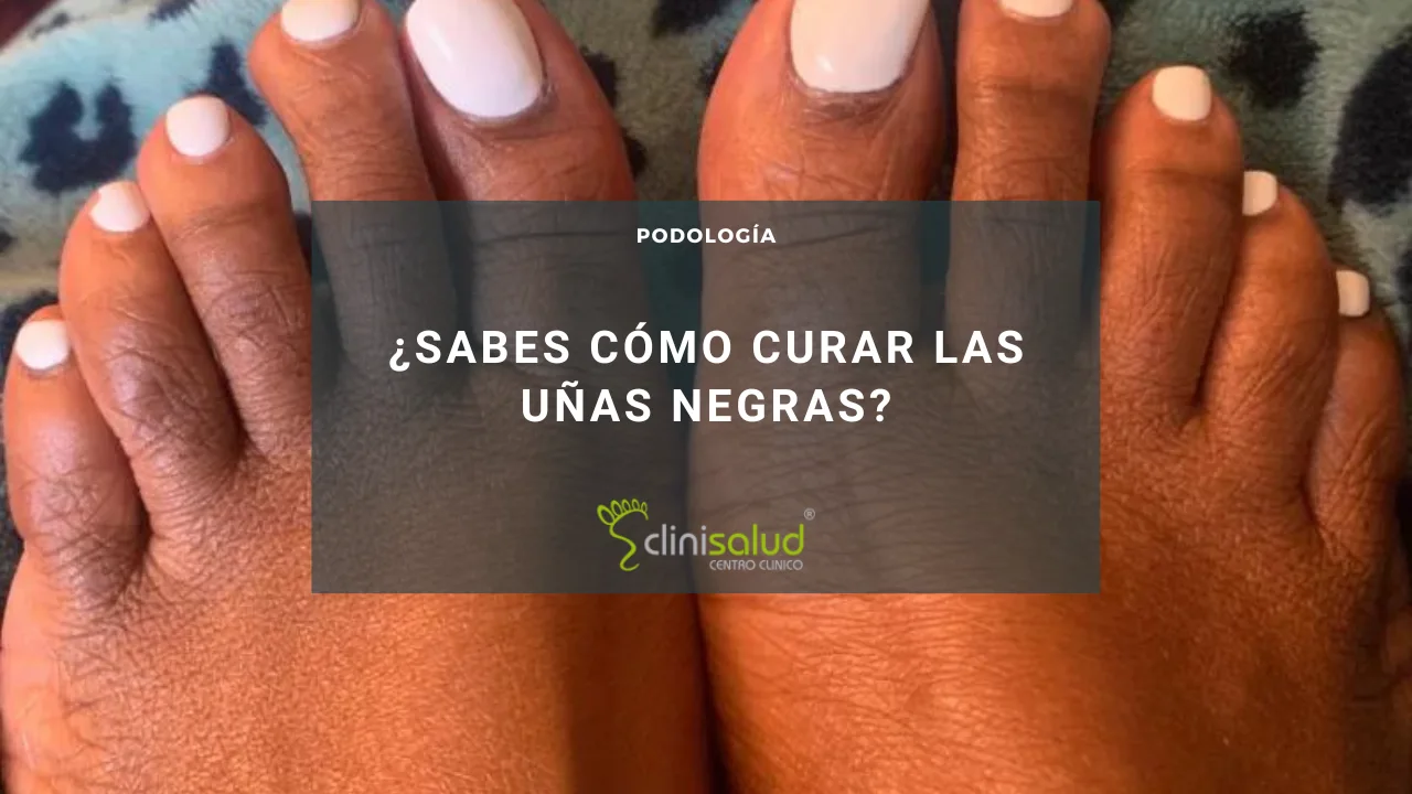 CURAR LAS UÑAS NEGRAS