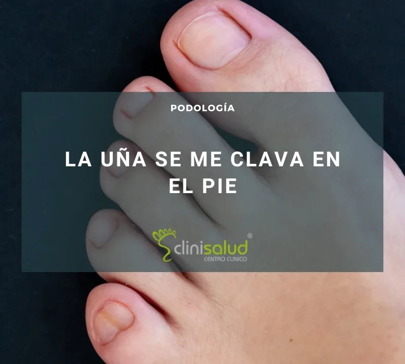 que son los uñas encarnadas