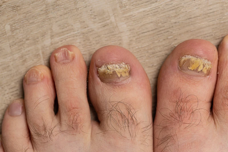 uñas amarillas hongos