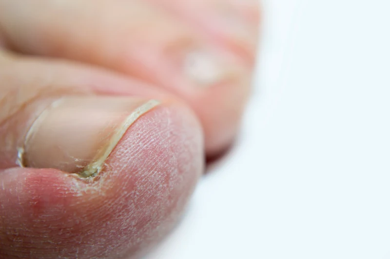 uñas con hongos
